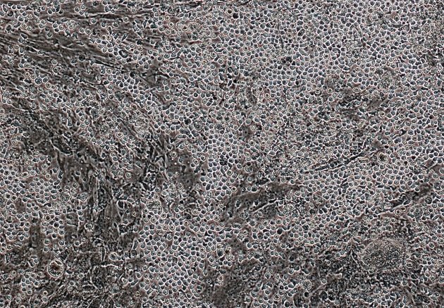 پیوند مغز استخوان